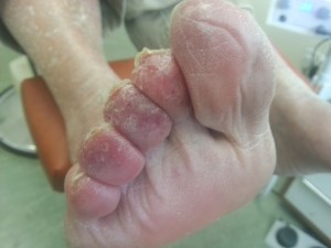 Chilblains